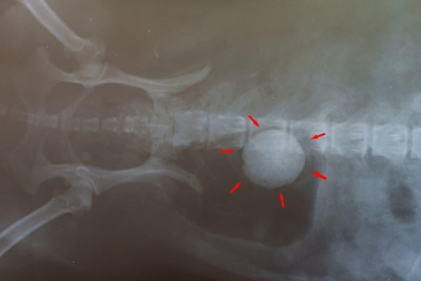 bladder stones